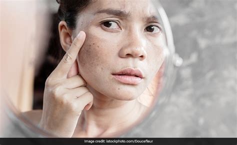 7 Home Remedies For Pigmentation Say No To Dark Spots And Yes To