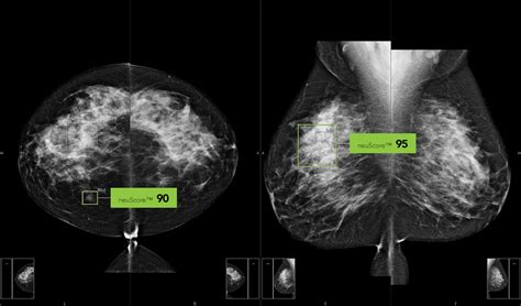 Evaluation Of Dense Breasts Curemetrix Dense Breast Mammogram
