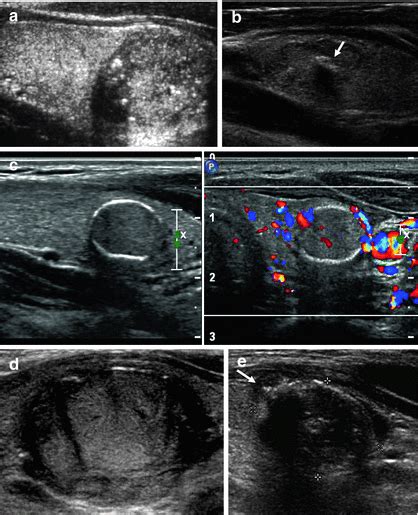 Ultrasound Of Thyroid Nodules Radiology Key