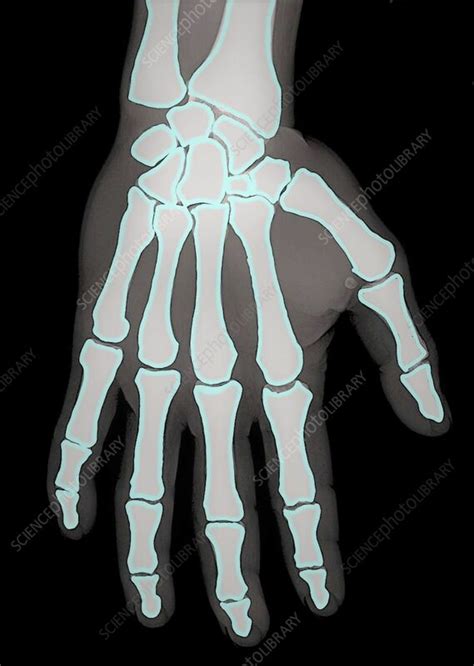 Healthy Hand X Ray Stock Image F0393313 Science Photo Library