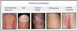 Photos of Guttate Psoriasis Mayo Clinic