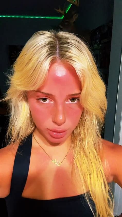 I Swapped Sunscreen For Tanning Oil And Now I Look Like A Tomato