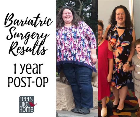 Bariatric Gastric Sleeve Surgery Update And Results 1 Year Post Op