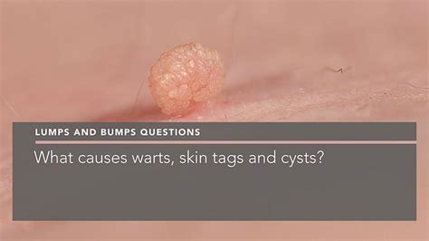 What Causes Warts Skin Tags And Cysts Penelope Pratsou Reading