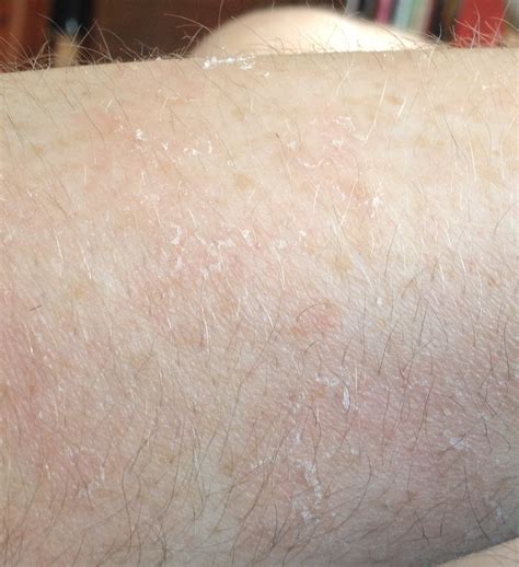 Patches Of Dry Skin Pictures Photos