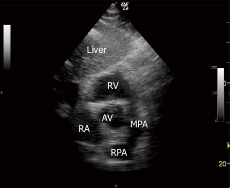 Subcostal Right Ventricular Inflow Outflow View Sonogram Ra Right