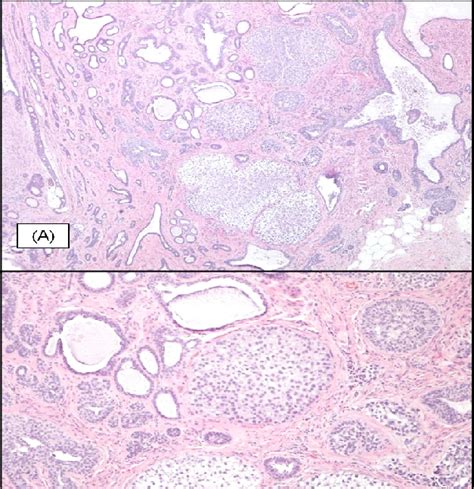 Hande Histology Of The Breast Lesion Demonstrating A Fibroadenoma With