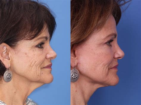 Facelift Before And After Pictures Case 86 Scottsdale Az Hobgood Facial Plastic Surgery