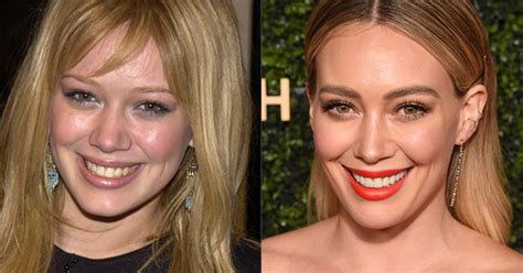 What Celebrities Looked Like Before And After Getting Veneers Beautyheaven
