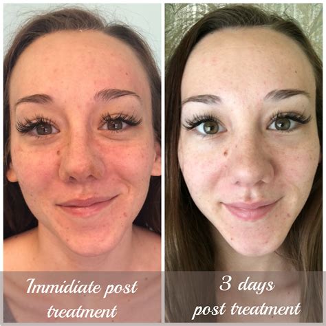 Client Beforeafter Treatment • Sleekskin® Aesthetics Of Scottsdale Az