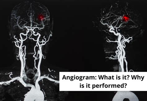 What Is Angiogram Why It Is And Riskfactors Of Angiogram