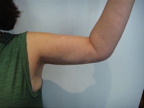 Arms Lipoedema After Liposuction London Dr Puneet Gupta Breast