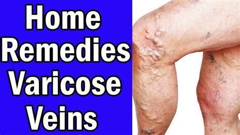 5 Home Remedies For Varicose Veins In Legs Youtube