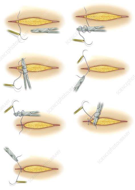 Suturing Of Surgical Incision Illustration Stock Image C0463002