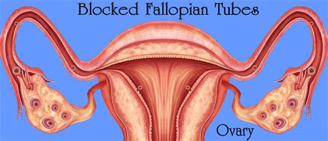 Blocked Fallopian Tubes Some Basic Symptoms And Causes
