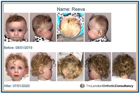 Reevas Brachycephaly Treatment