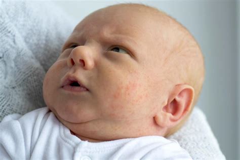 Top 10 Baby Rash Causes Waxelene