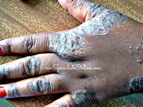 Hand Eczema Skin Specialists Online