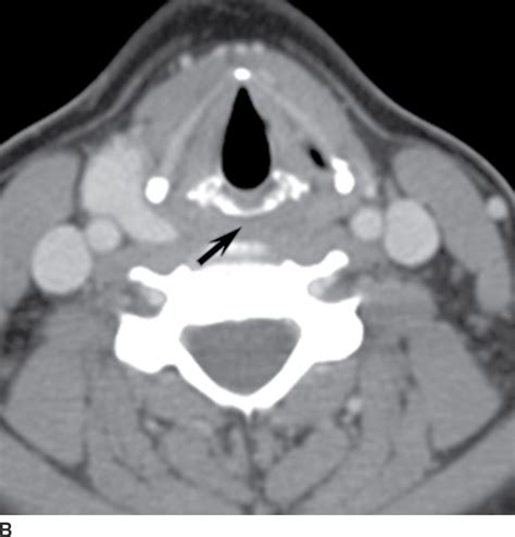 Mucosal Cancers Neck Primaries And The Lymph Nodes Radiology Key
