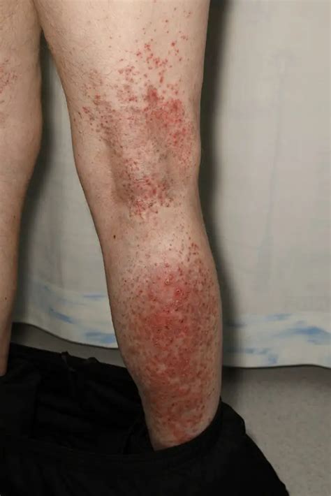 Itchy Skin Rash After Surgery Causes Diagnosis Treatment