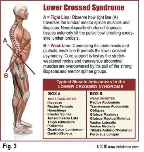 Lower Crossed Syndrome Mcisaac Health Systems Inc