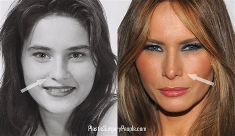 First lady melania trump, washington d. Did Melania Trump Have Plastic Surgery Before She Became ...
