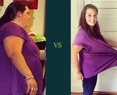 La Weight Loss Surgery Before After Photos Healthylifebariatrics