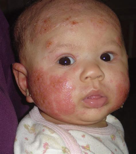 Allergies And Neonatal Acne Baby Acne Picture