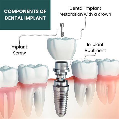 Components Of Dental Implants Riverside Oral Surgery