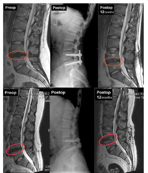 Two Patients With L4s5 Disc Herniation That Underwent Discectomy And