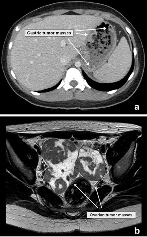 Abdominal Ct Scan With Gastric Tumor A And Mri Showing Bilateral