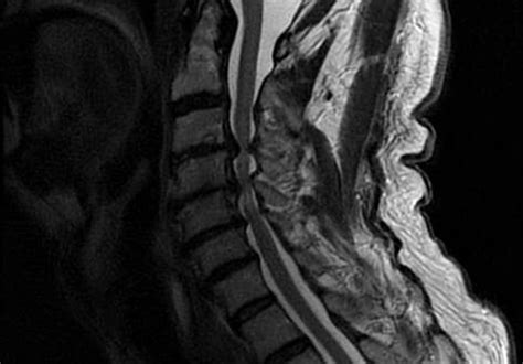 Cervical Myelopathy Discoveries Paving The Way To Better Care Mayo