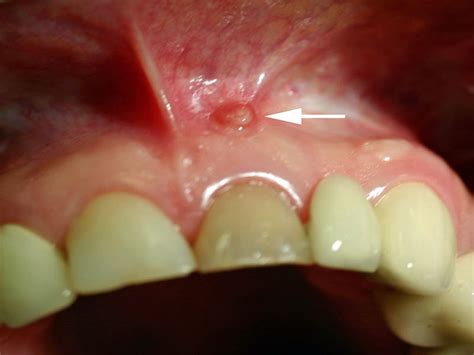 What Does An Abscess On The Gum Look Like Directorio Odontológico