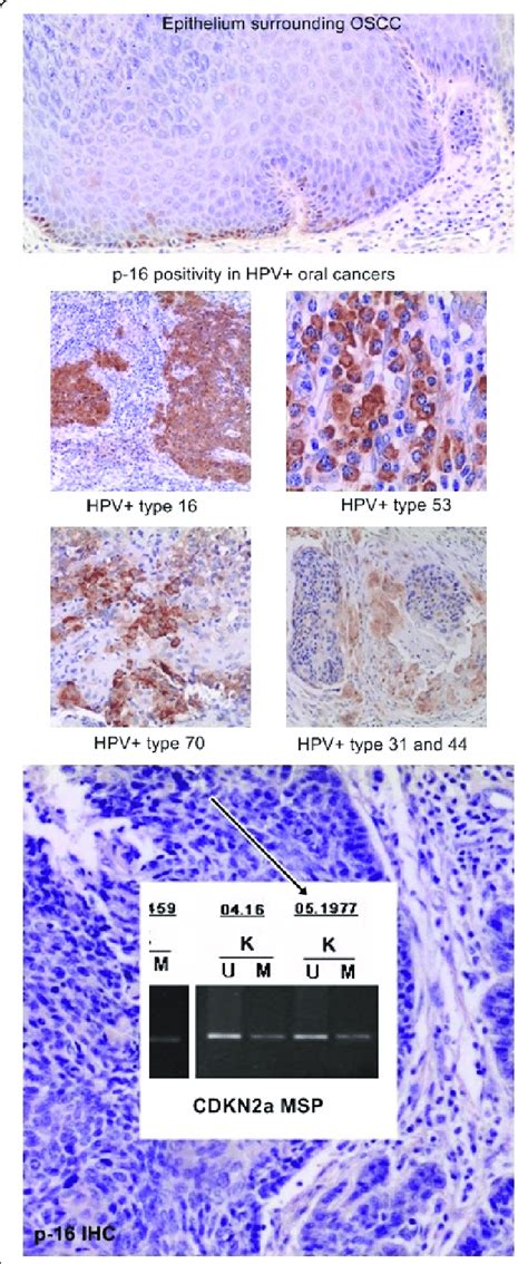 Ihc Expression Of P16 Protein In Representative Hpv Positive Dna Type
