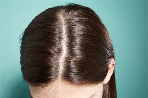 my hair is thinning 5 reasons for hair loss explained