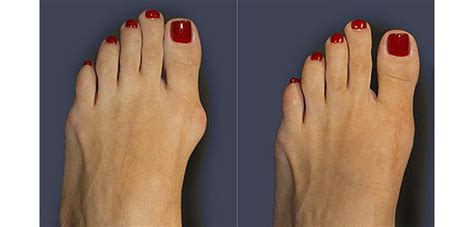 Bunion Surgery Dr Alice Wang