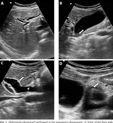 Figure 1 From Double Duct Sign Do Not Forget The Gallstones
