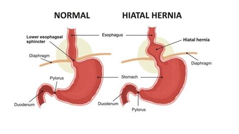 Common Symptoms Of Hiatal Hernia Page 8 Entirely Health