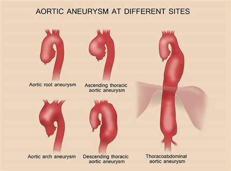 Aortic Dissection Aortic Aneurysm Types Causes Symptoms Hot Sex Picture