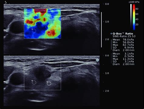 A 53 Year Old Woman With Surgically Proven Papillary Thyroid Carcinoma