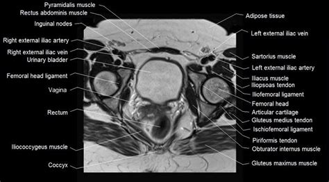 This webpage presents the anatomical structures found on knee mri. mri female pelvis anatomy axial im1age 2 | Pelvis anatomy ...