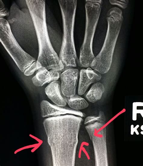 Wrist Xray Shows Buckle Fractures Of The Radius And Ulna