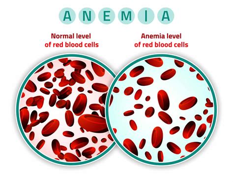 Infant Anemia Anemia In Infants Michigan Birth Injury Lawyer