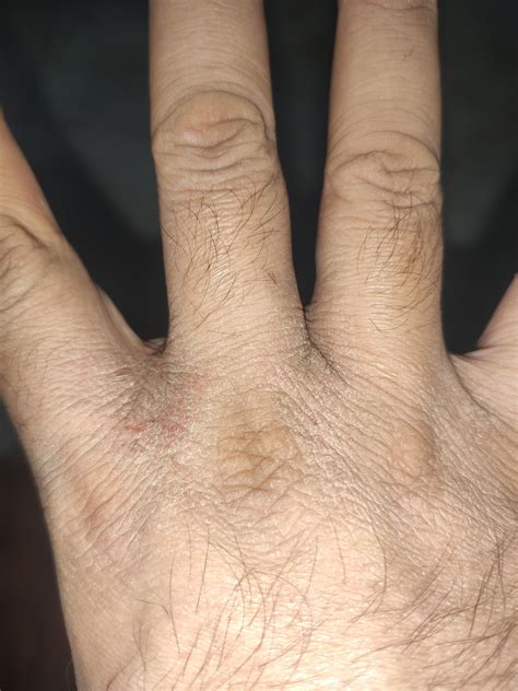 How Can I Cure This From 2 Weeks I Am Having Super Dry Skin Between