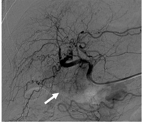 Patient No 5 Ct Scan Before Embolization Of The Lesion Arrow Using