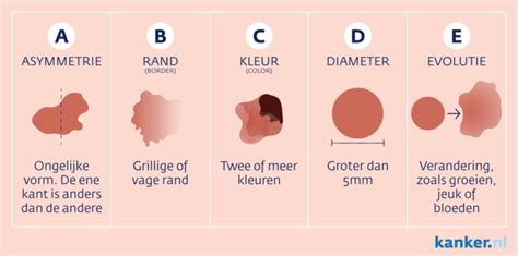 Melanoom Huidkanker Kwaadaardige Moedervlek Tergooi Mc