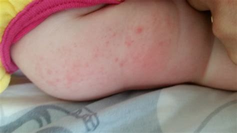 Rash Update Its Roseolainfant Measles January 2015