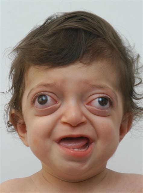 A Rare Syndrome Disfigured His Face At Birth Newz