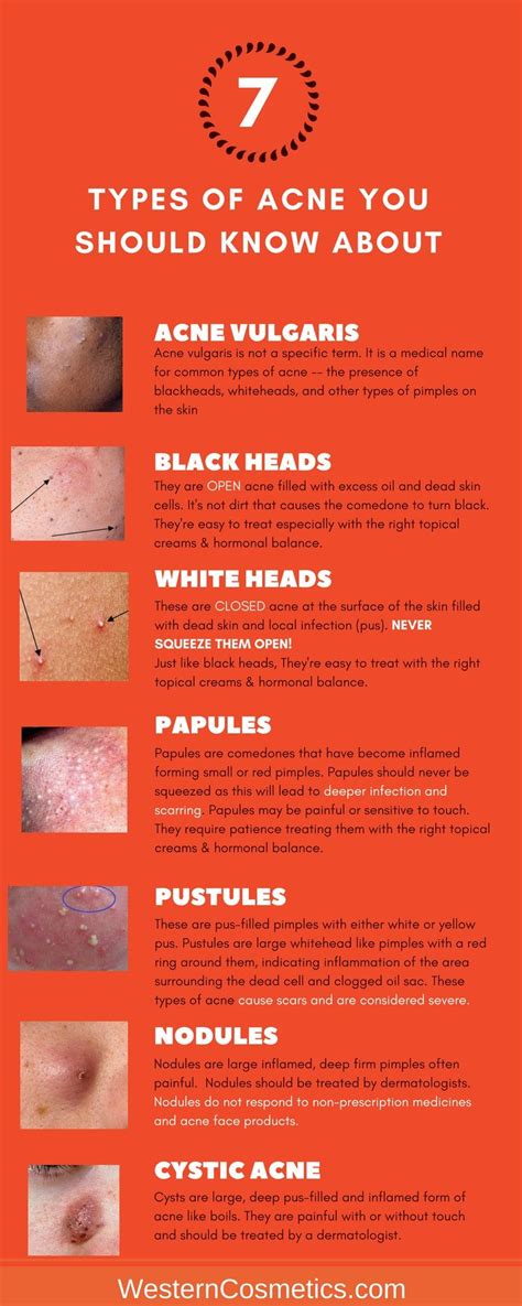 7 Types Of Acne You Need To Be Aware Of And How They Are Treated