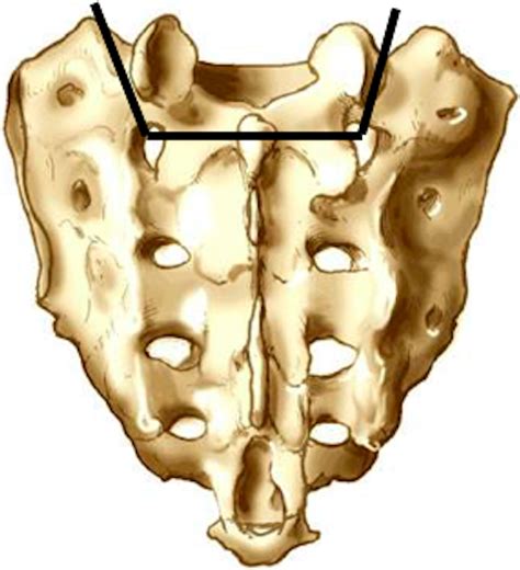 Sacral Pedicle Subtraction Osteotomy For An Extreme Case Of Positive